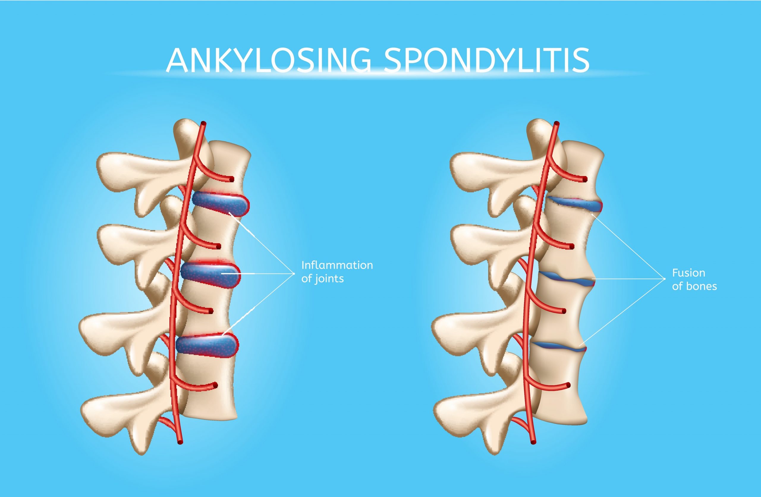 Ankylosing spondylitis massage: Benefits and risks