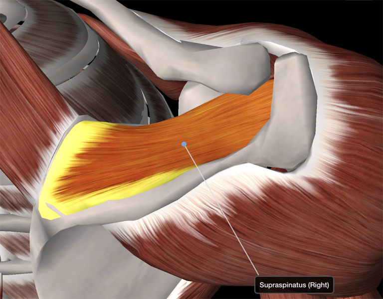 Алкоголизация Supraspinatus